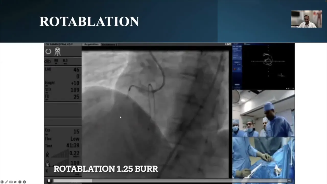 Rotablation procedure in action
