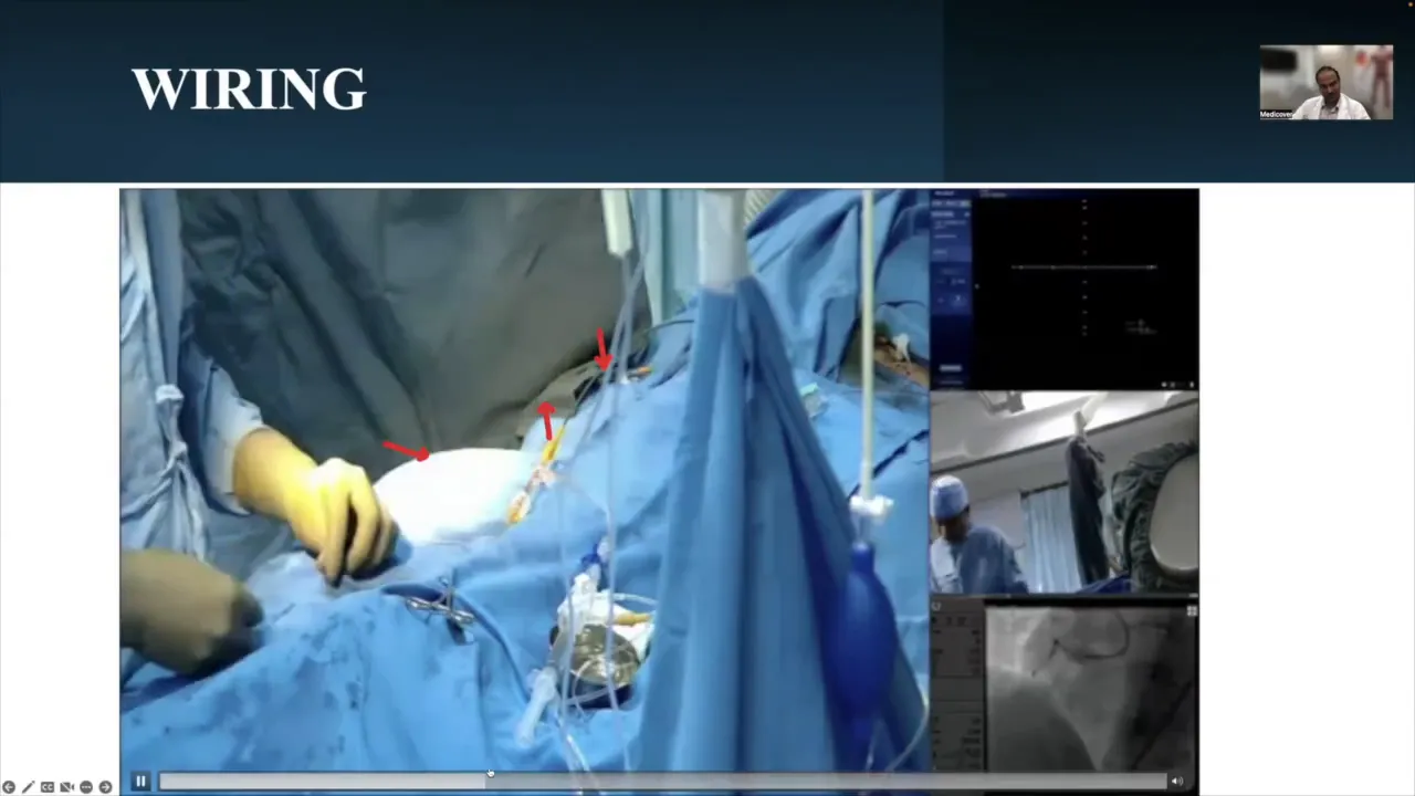 Filter XTR wire crossing the lesion
