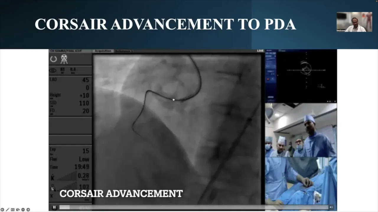 Corsair catheter advancing through the lesion