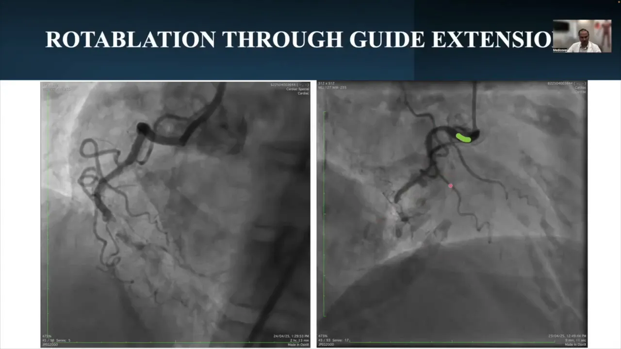 Guide extension catheter in place