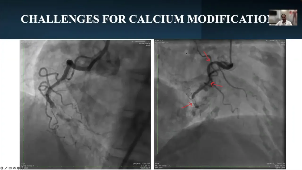 Calcified right coronary artery with loops