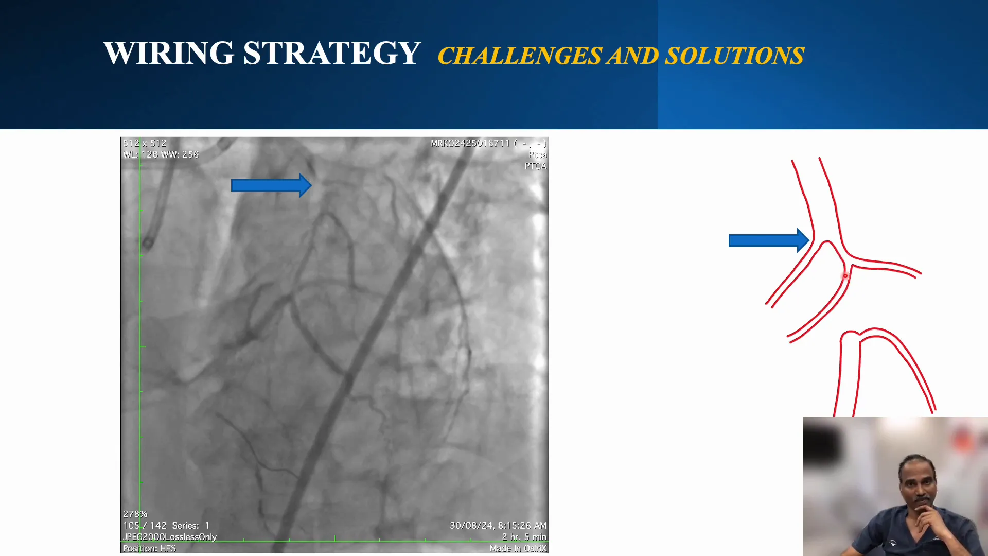 Selected side branch for IVUS-guided cap puncture