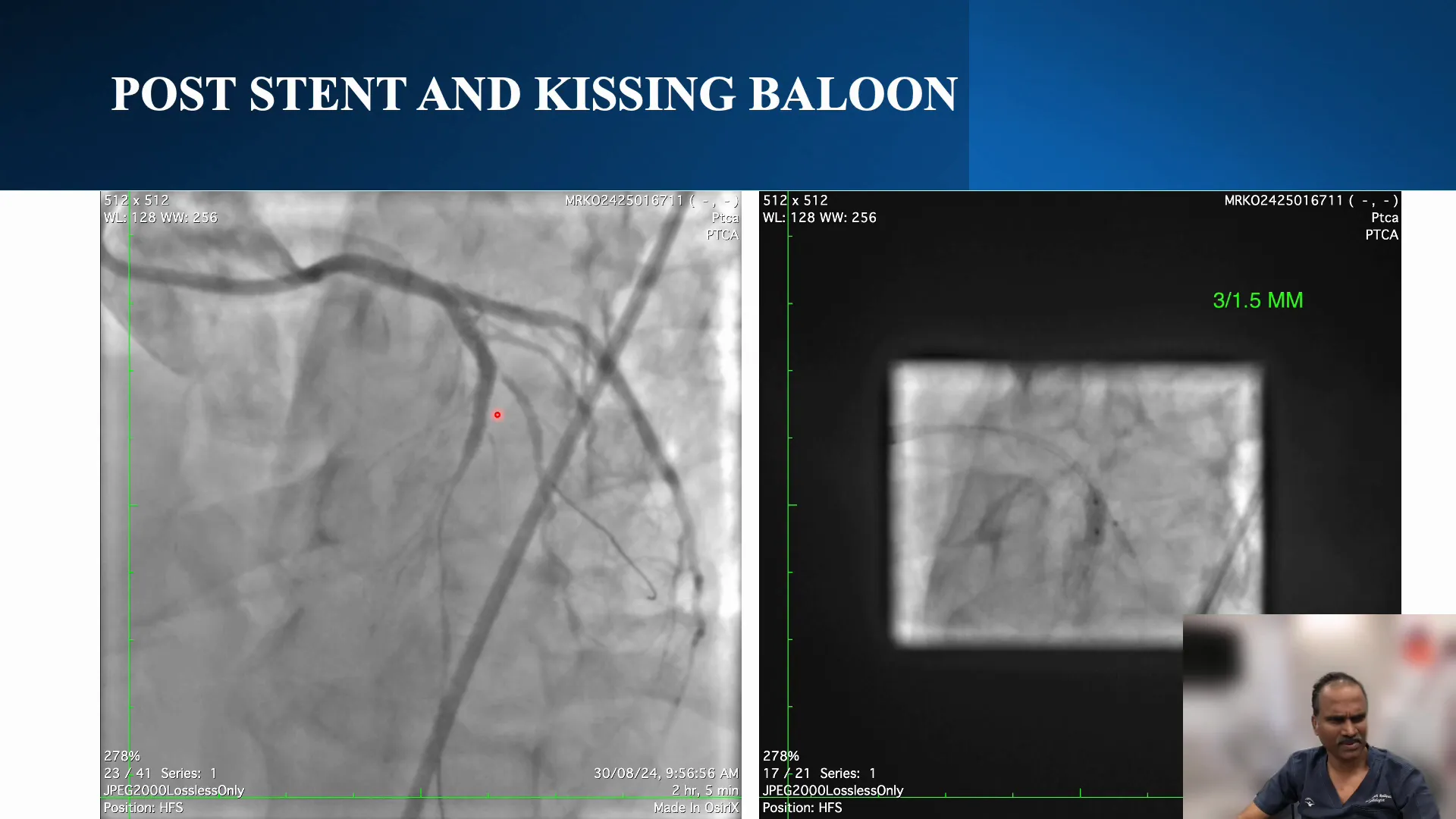 Stent placement across the diagonal branch post-procedure