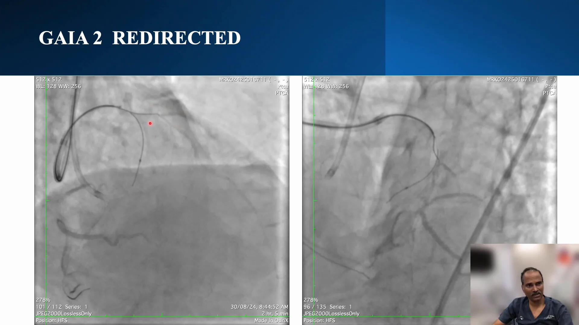 Wire positioned at the distal cap