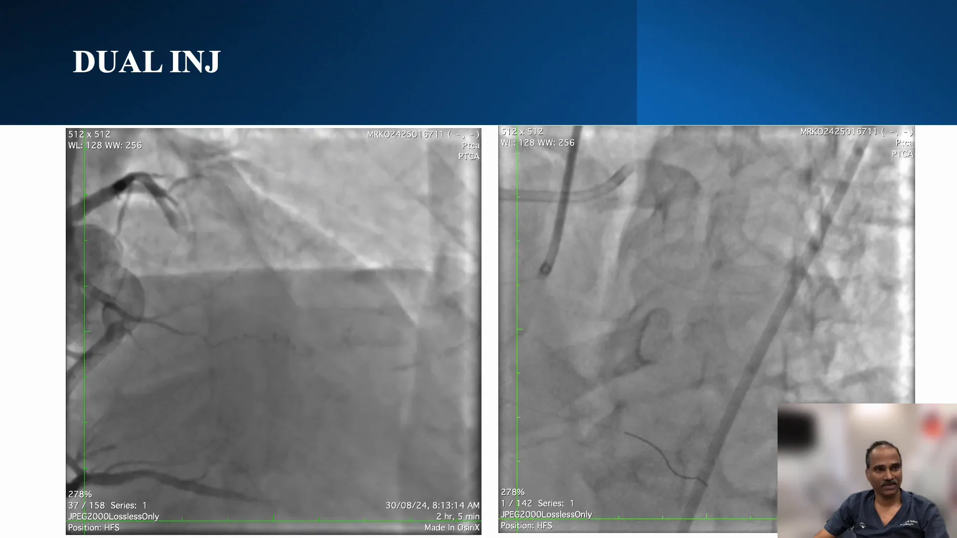 Dual injection showing CTO segment and wire position