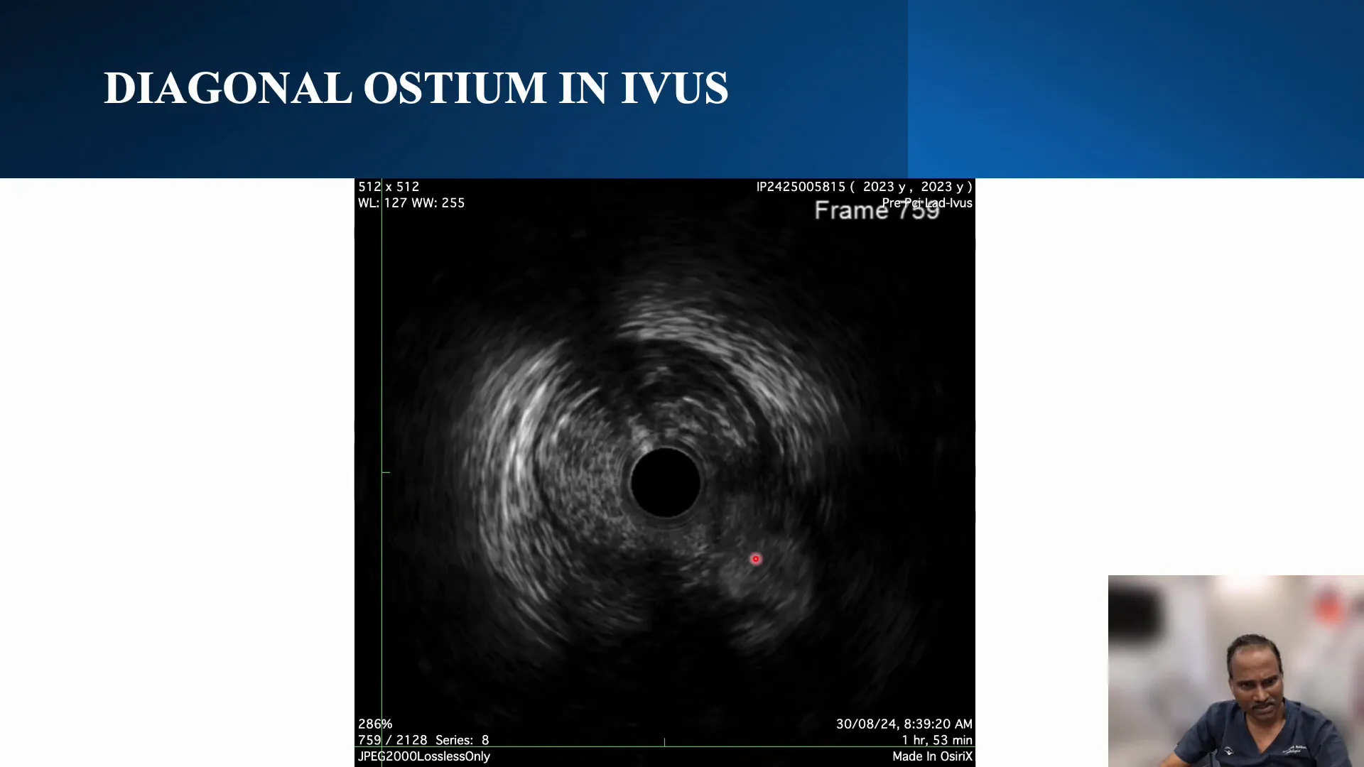 Flap over the diagonal osteum identified through IVUS