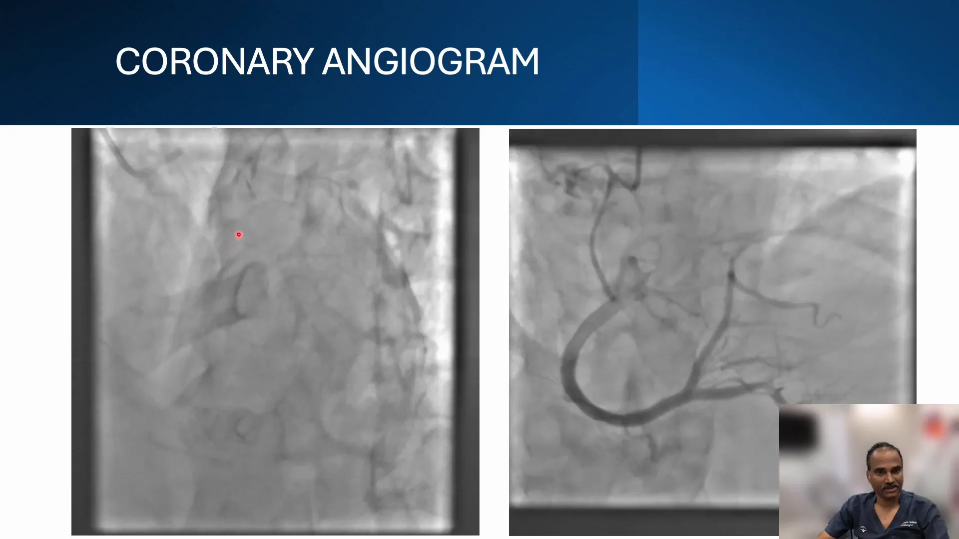 Coronary angiogram with retrograde injection