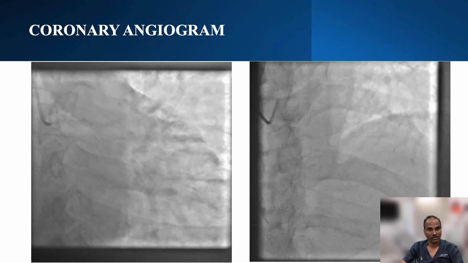 Angiogram showing total occlusion in mid-LAD