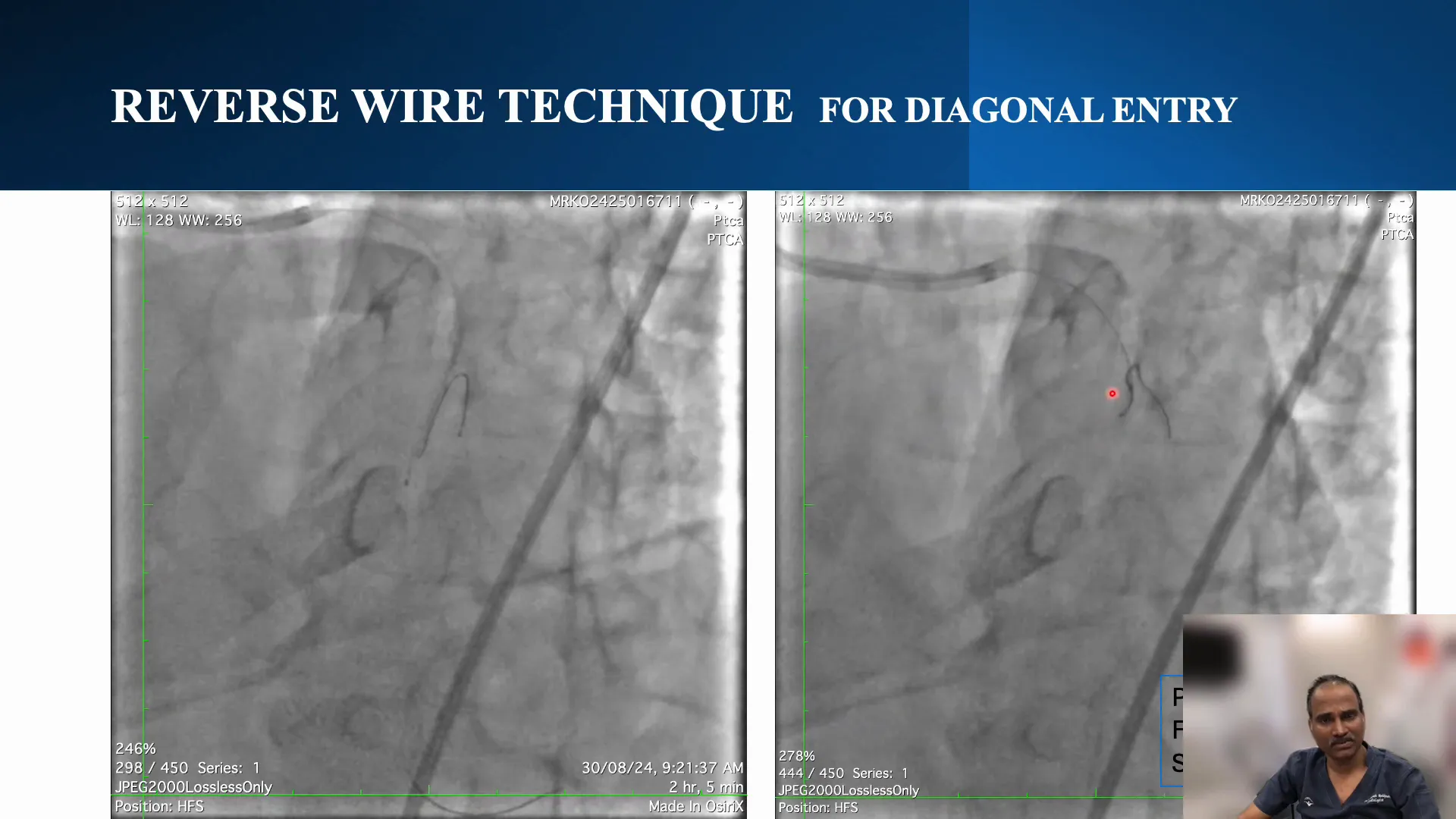 Wire entering the target diagonal branch using the reverse wire technique