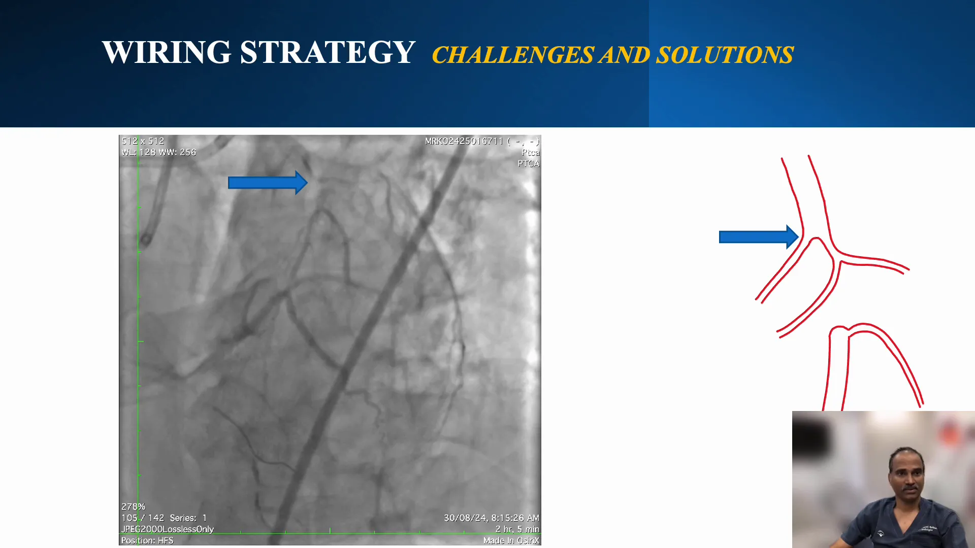 Angiogram highlighting the ambiguous cap and side branches