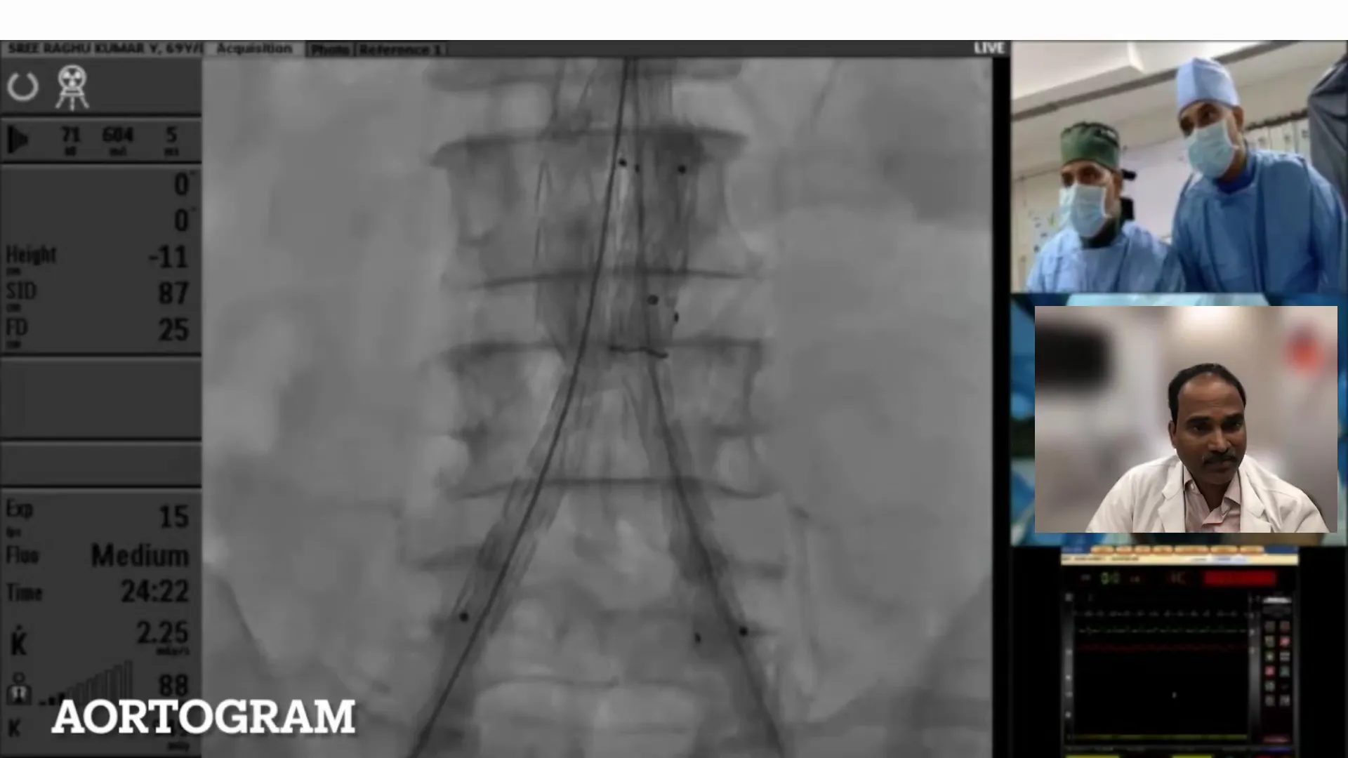 Post-deployment angiogram showing narrowing