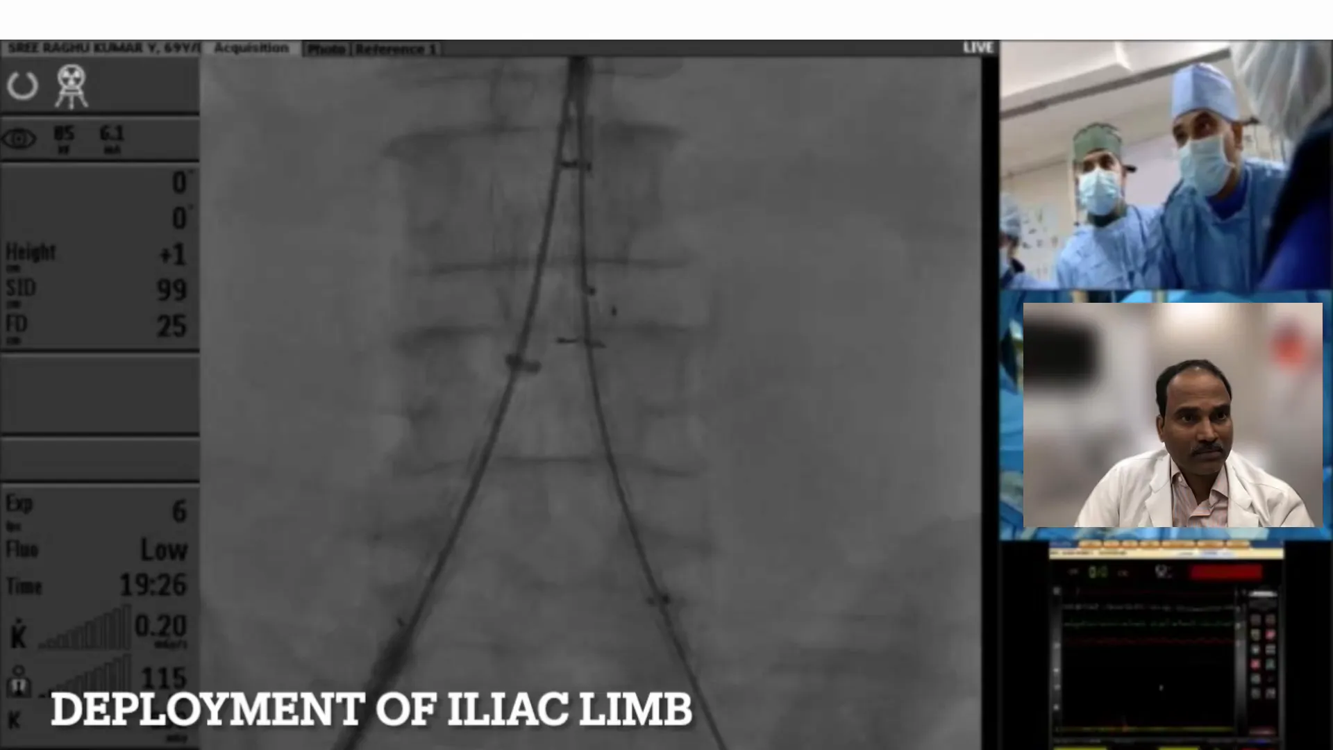 Deploying the left iliac extension