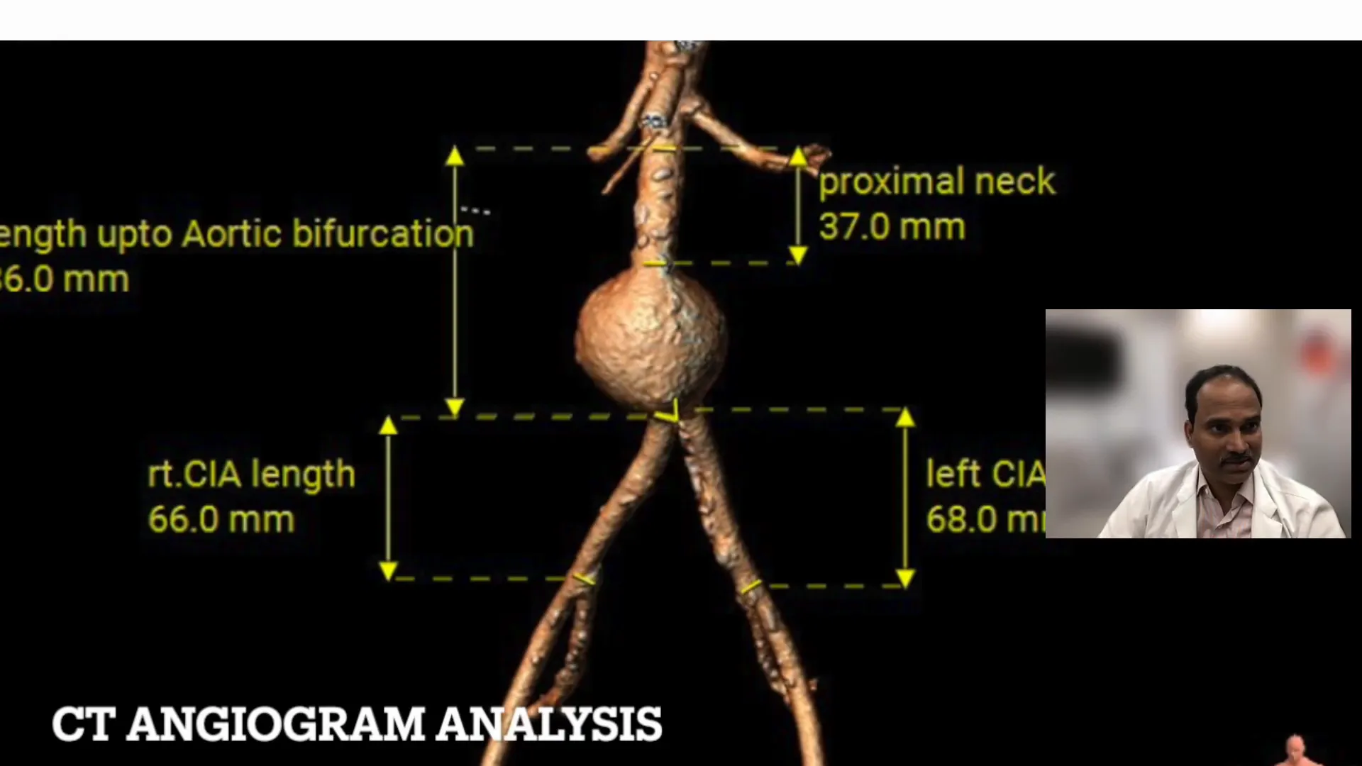 Graft size and landing zone