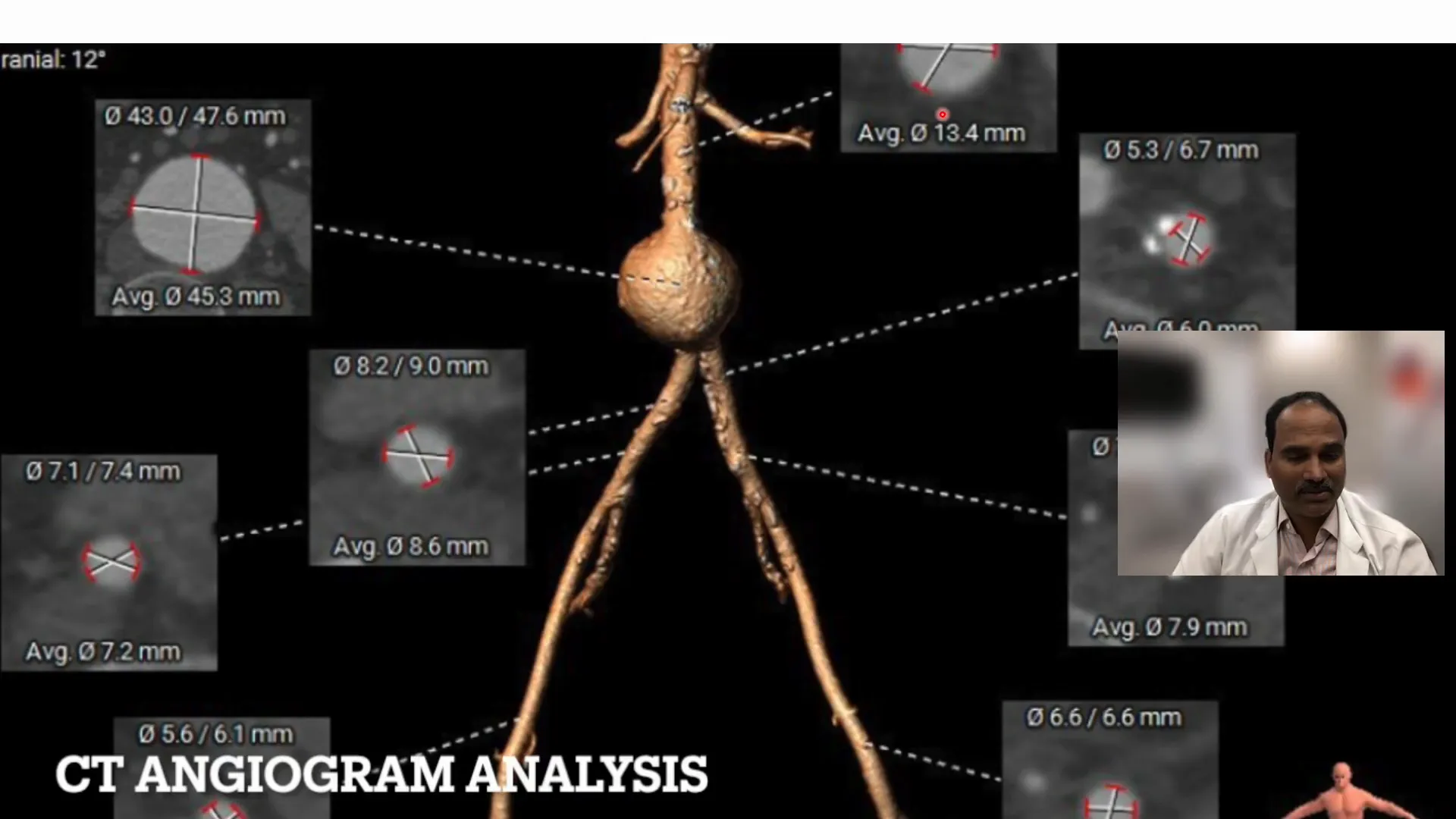 CT scan showing small aorta and aneurysm