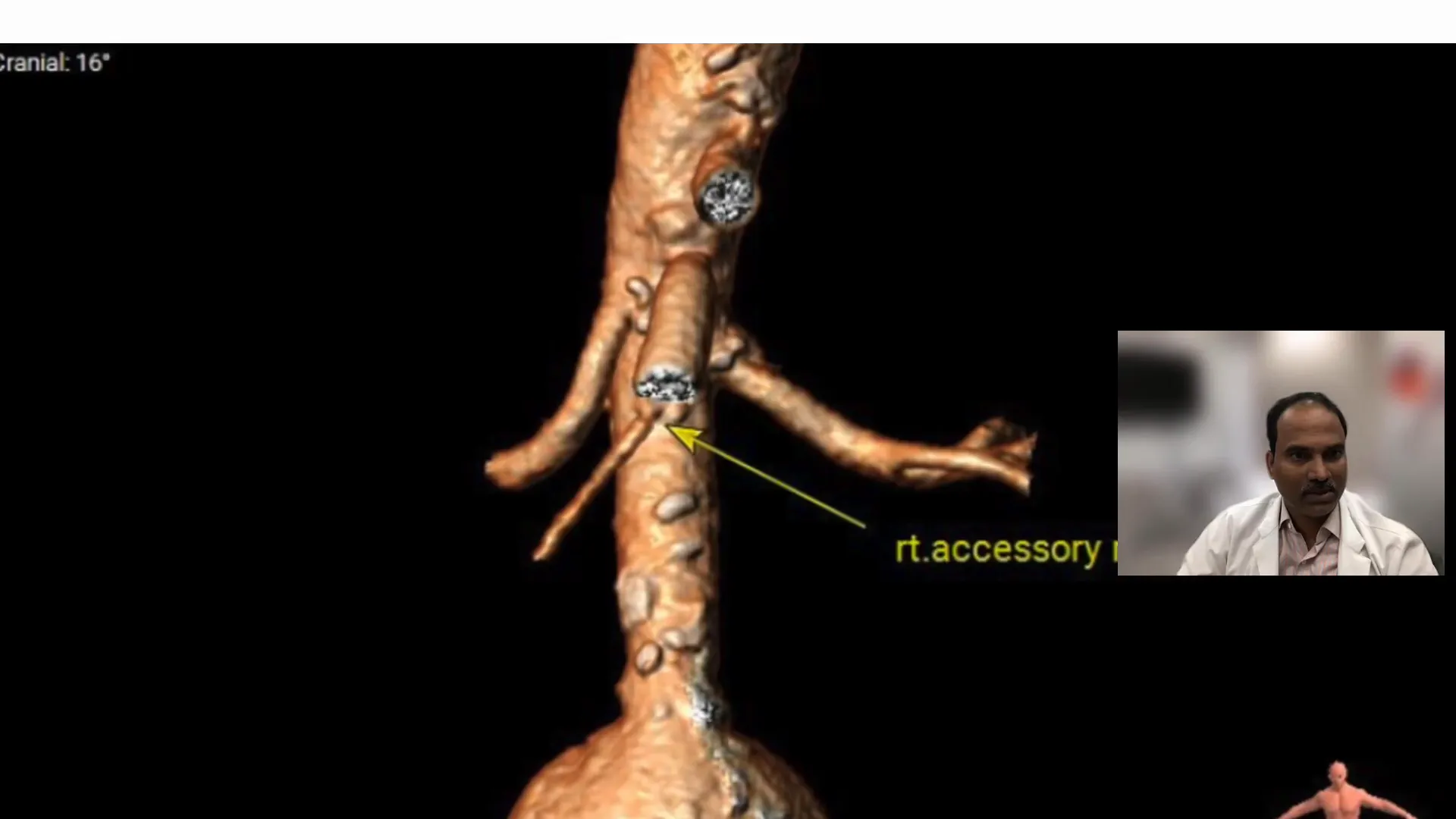 Accessory renal artery landmark
