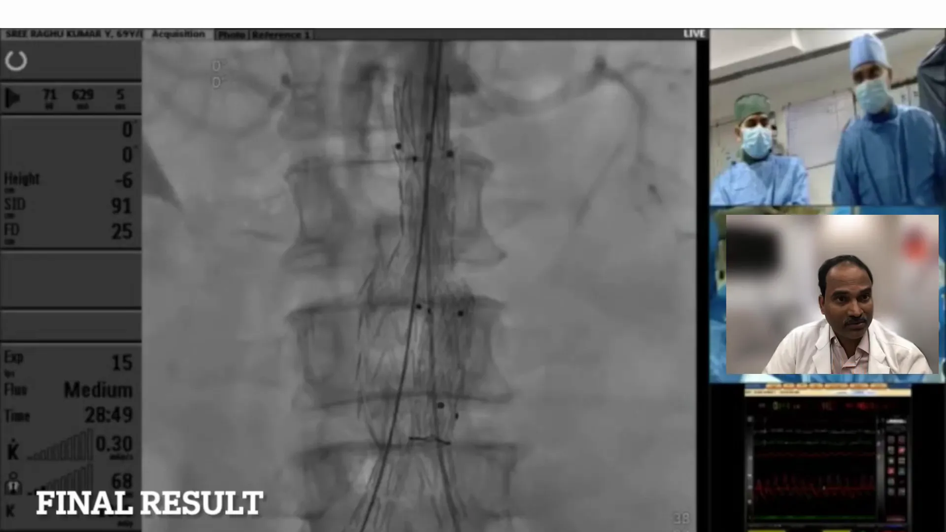 Final angiogram confirming graft integrity