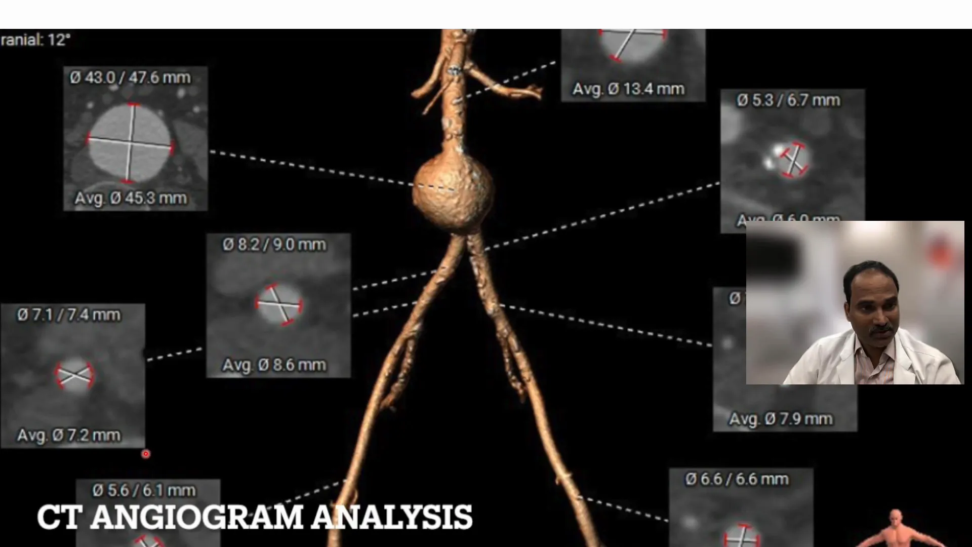 Iliac artery measurements