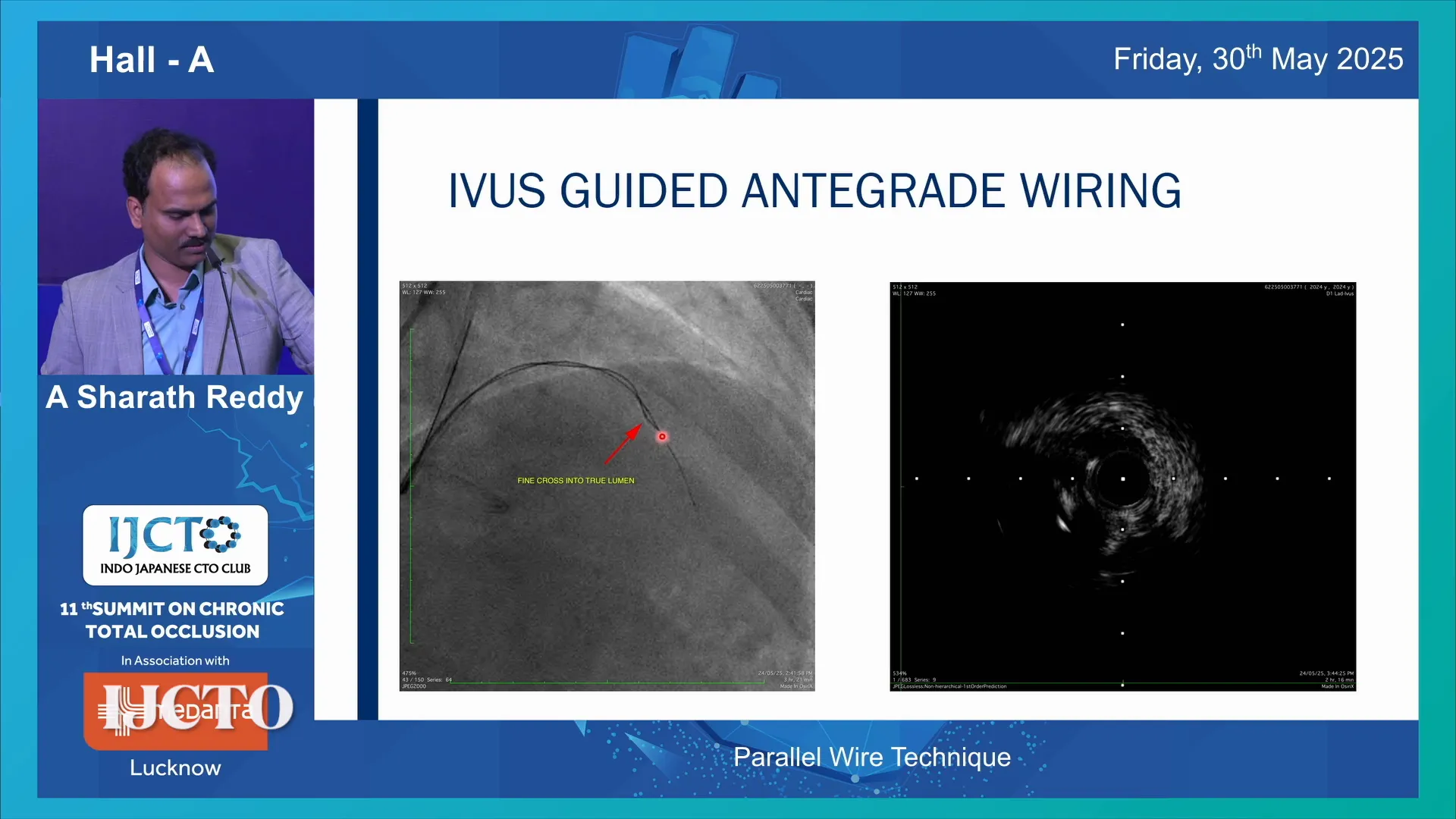 Iris catheter and parallel microcatheter used for true lumen wiring