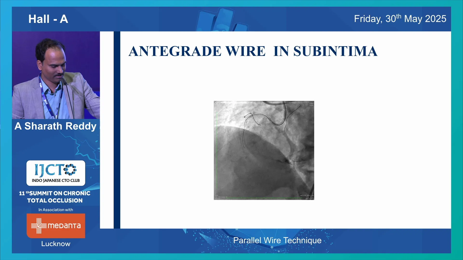 Subtimal position of first wire in mid RCS CTO