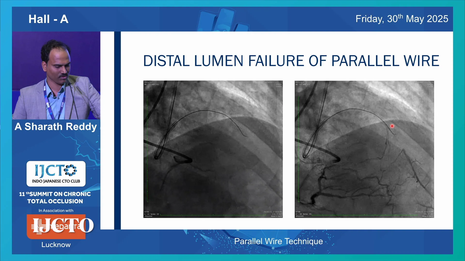 Distal vessel visibility reduced after failed parallel wire attempts