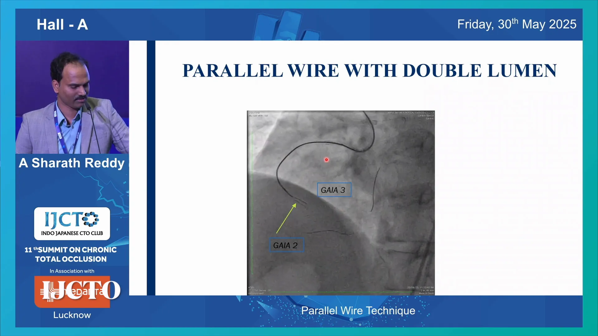 Parallel wire technique with two wires used as roadmap