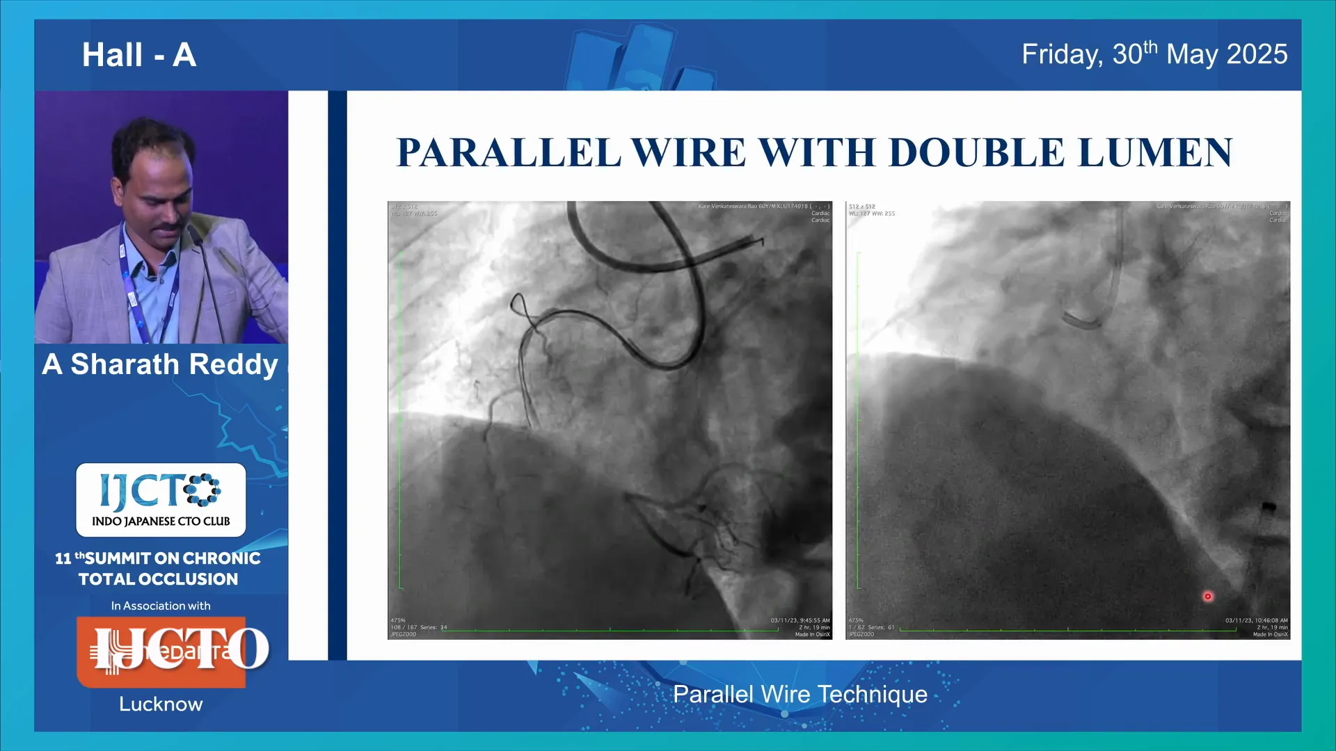 Second wire directed into true lumen in two orthogonal views