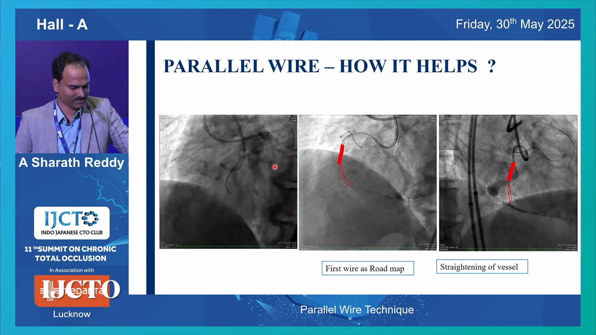 Subintimal position of first wire illustrating need for parallel wire technique