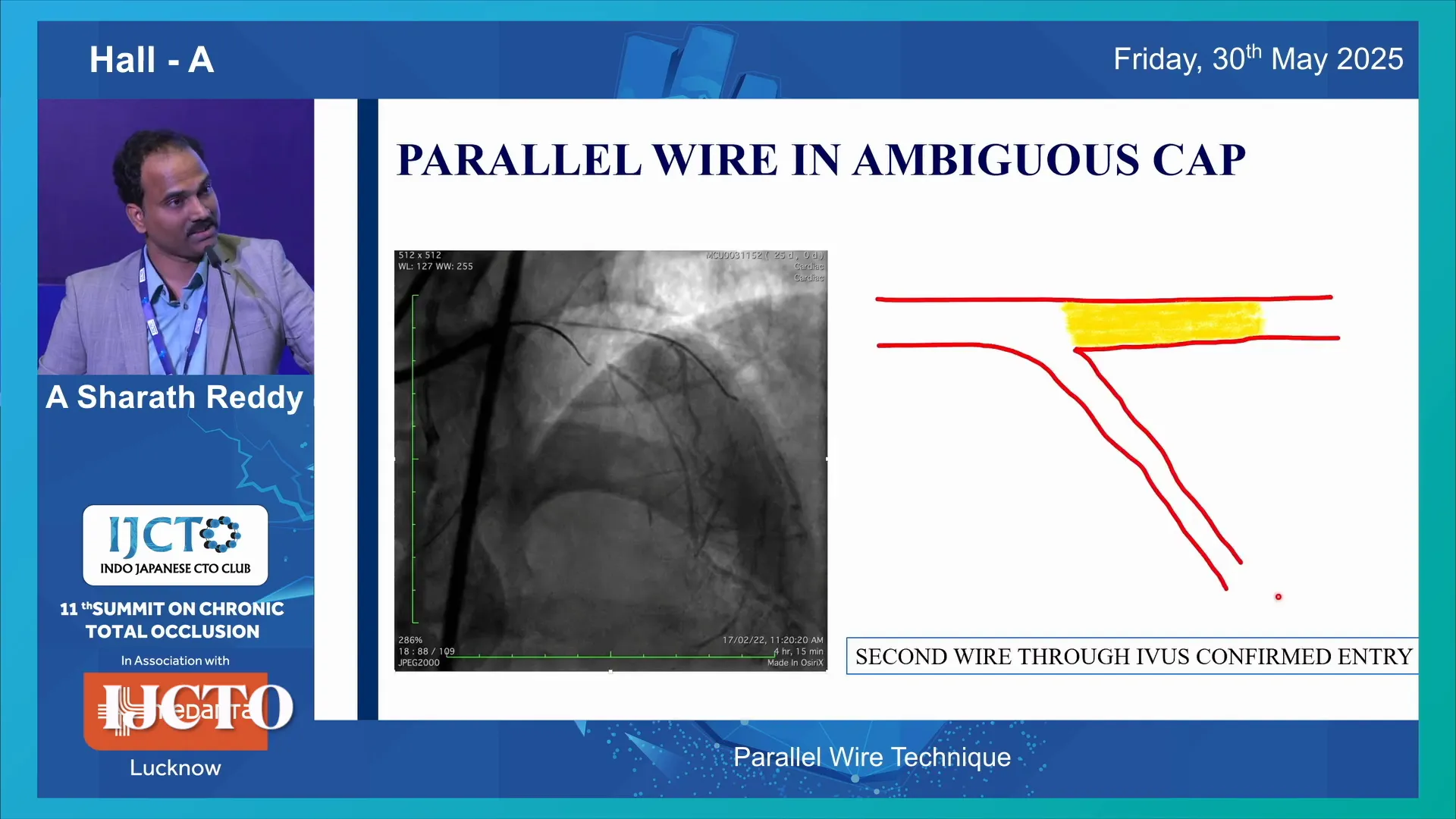 IVUS guided cap puncture and parallel wire advancement