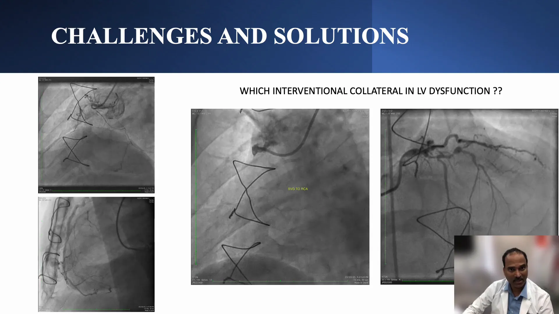 Choosing SVG to RCA as retrograde channel due to patient's LV dysfunction