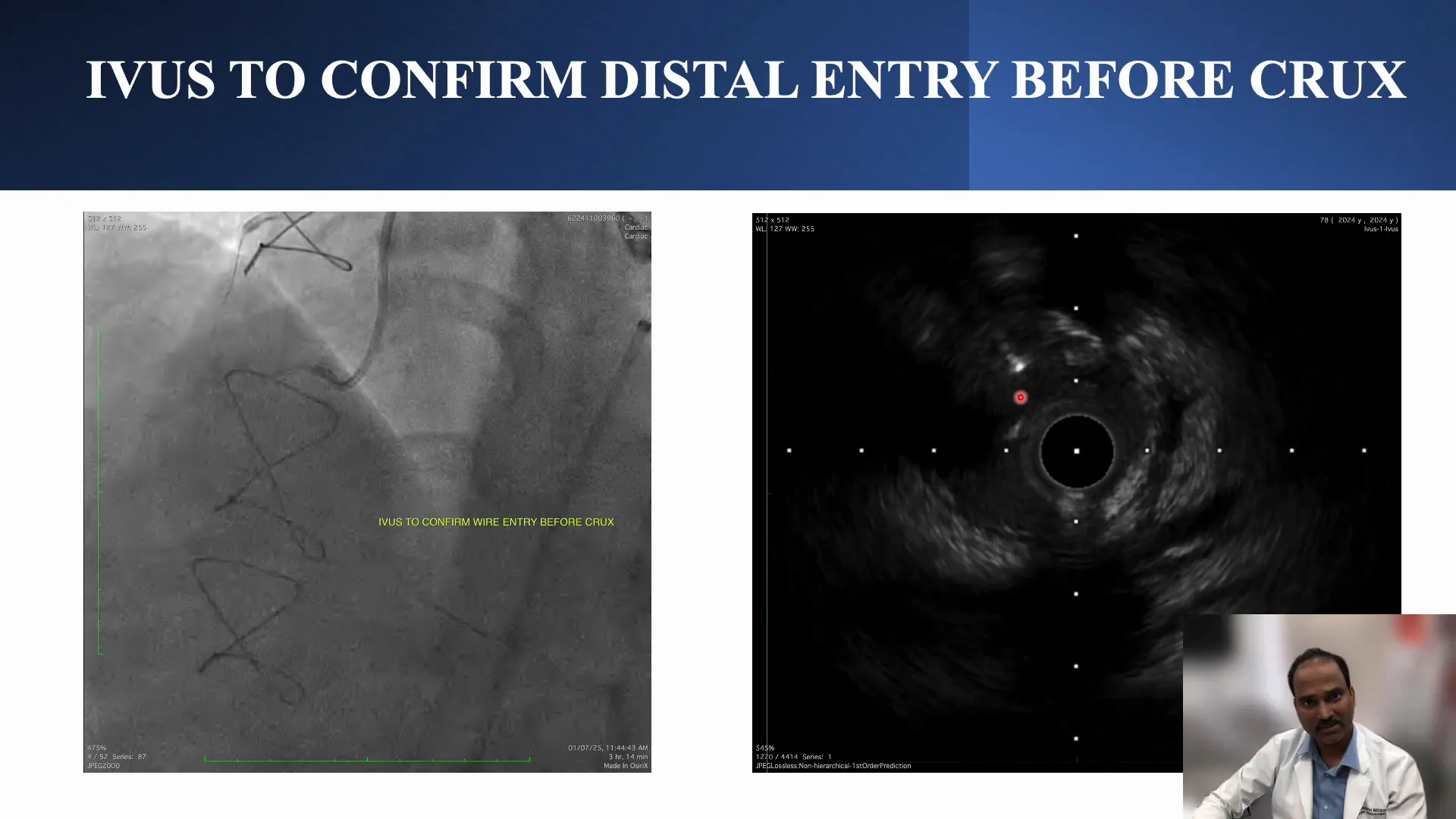 Intravascular imaging showing true lumen and subintimal space