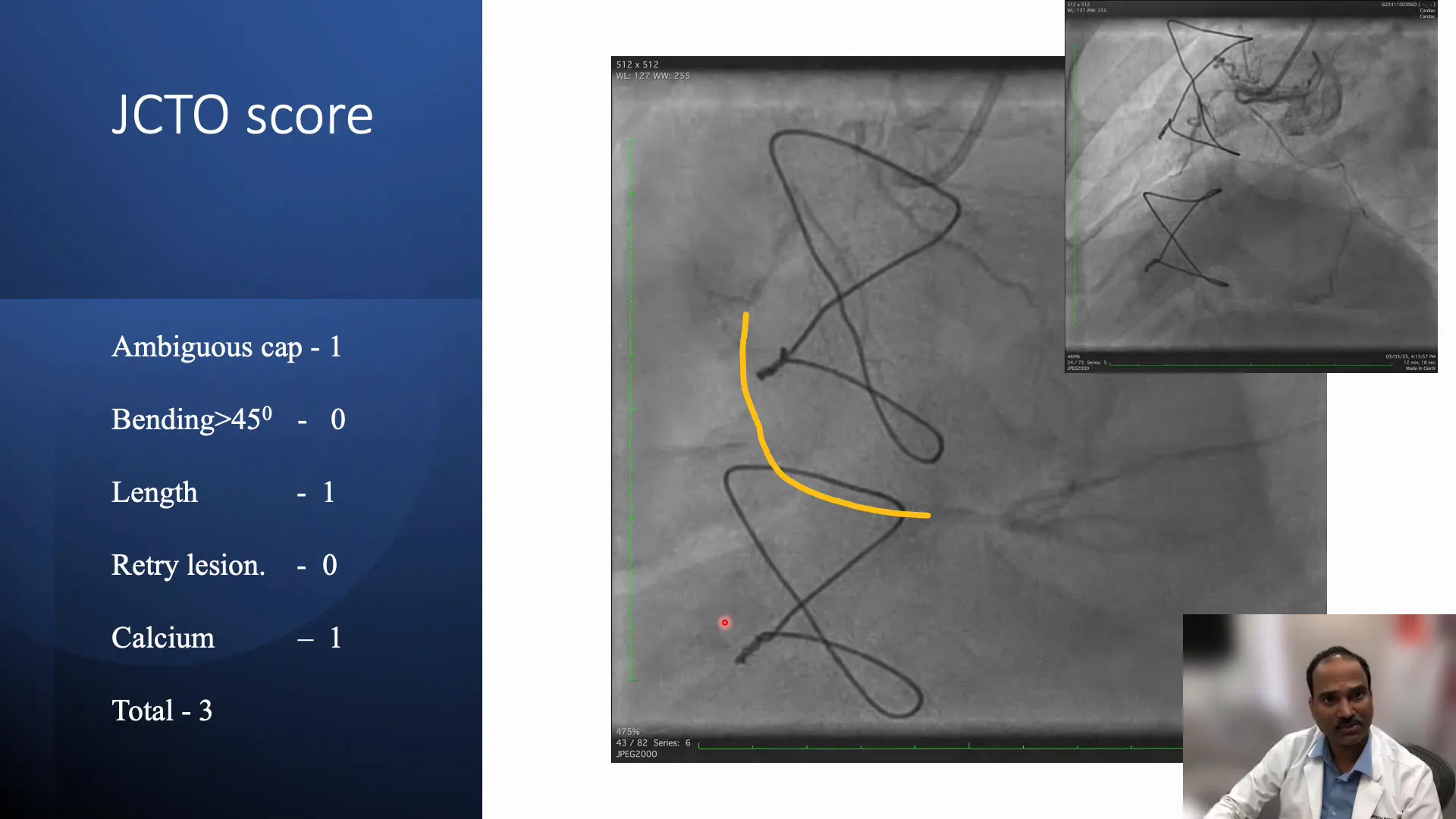 J-CTO scoring considerations and angiographic visibility of RCA lesion