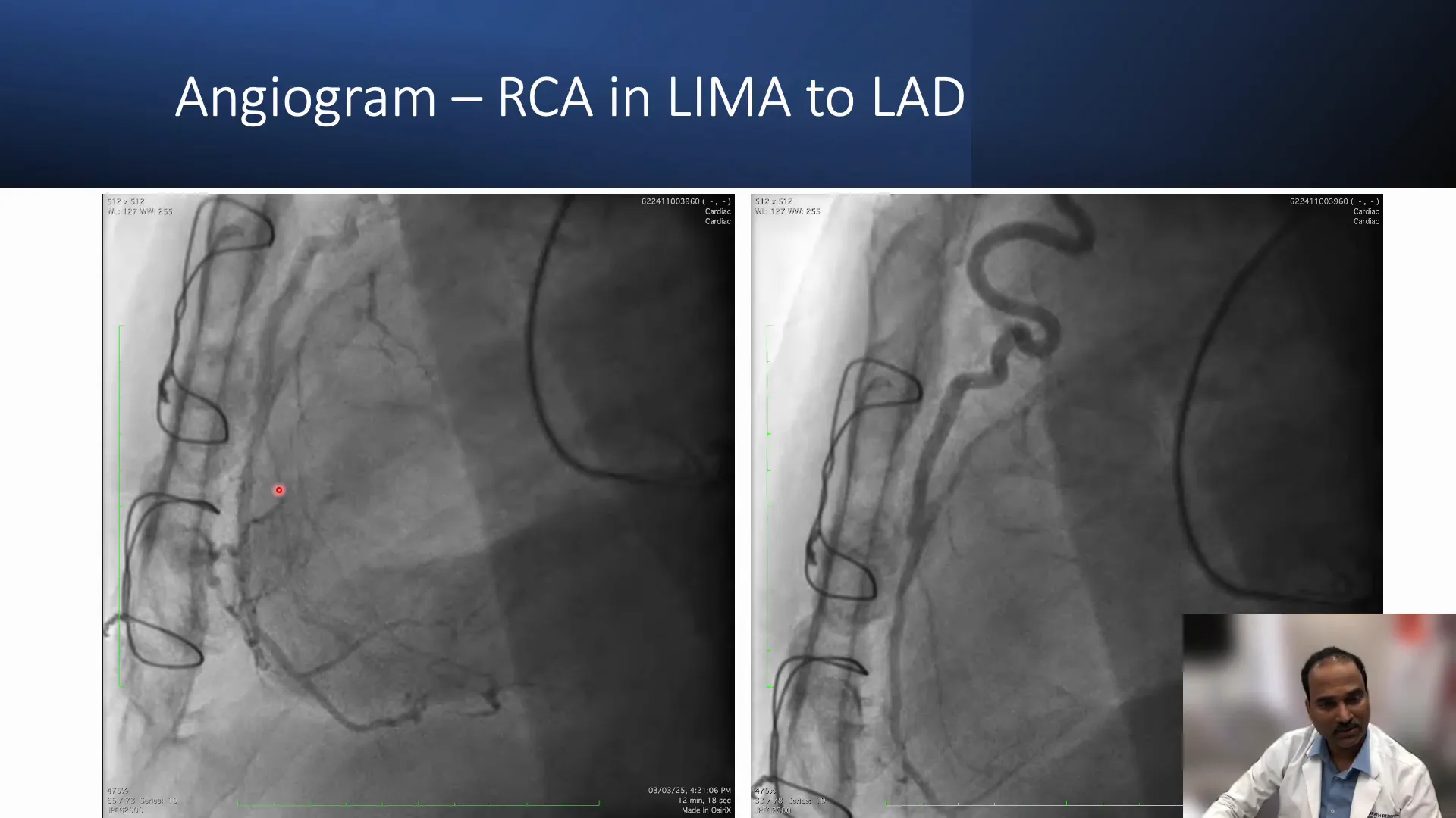 Collateral filling of distal RCA via posterolateral branches and LIMA graft