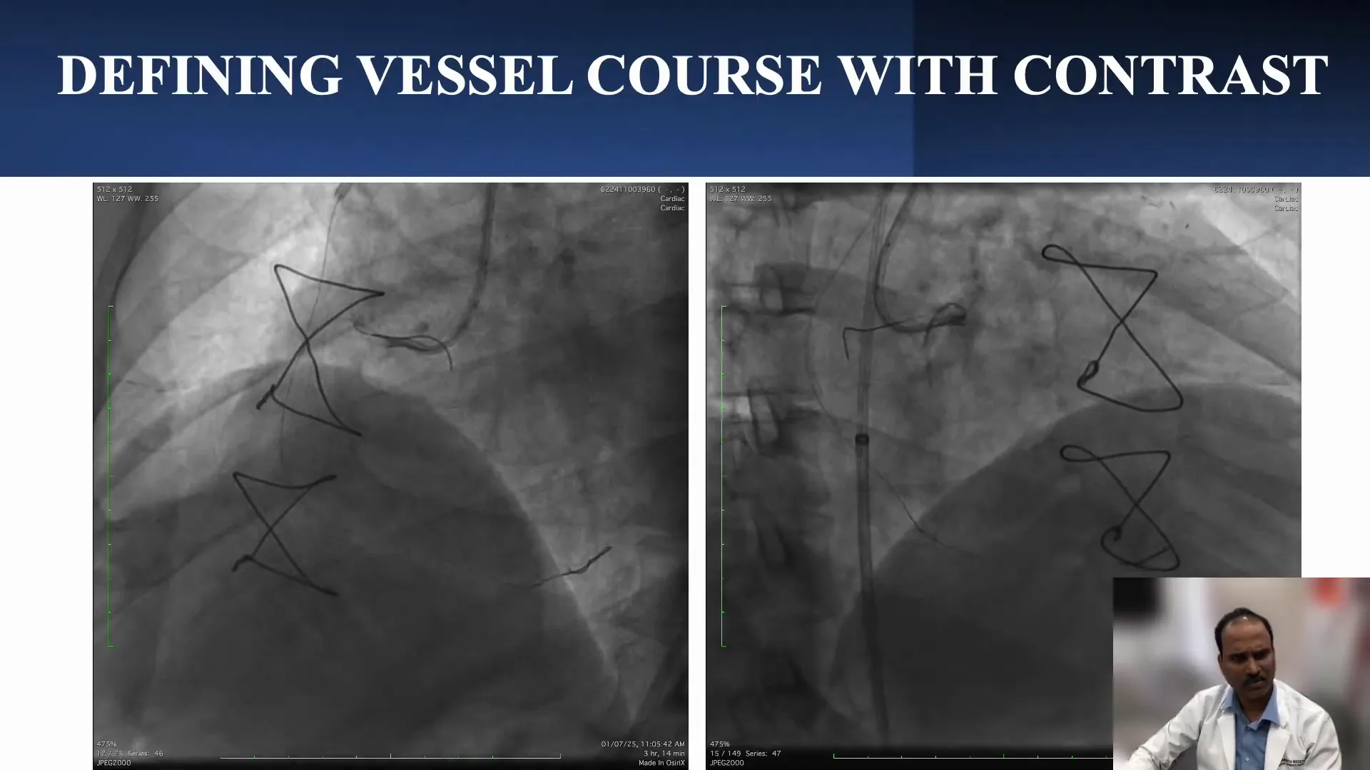 Contrast injection revealing wire course outside true lumen