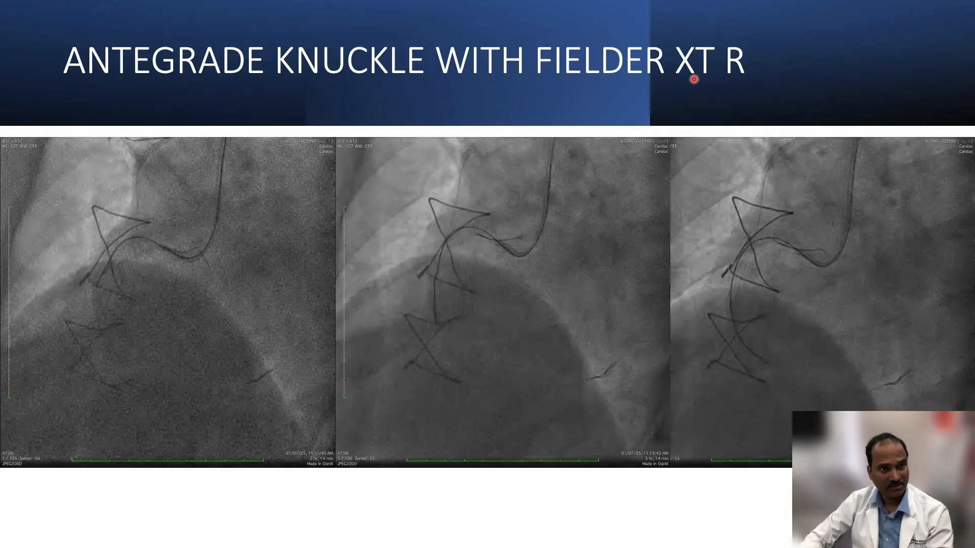 Knuckled Filter XTR wire advanced to navigate ambiguous vessel course