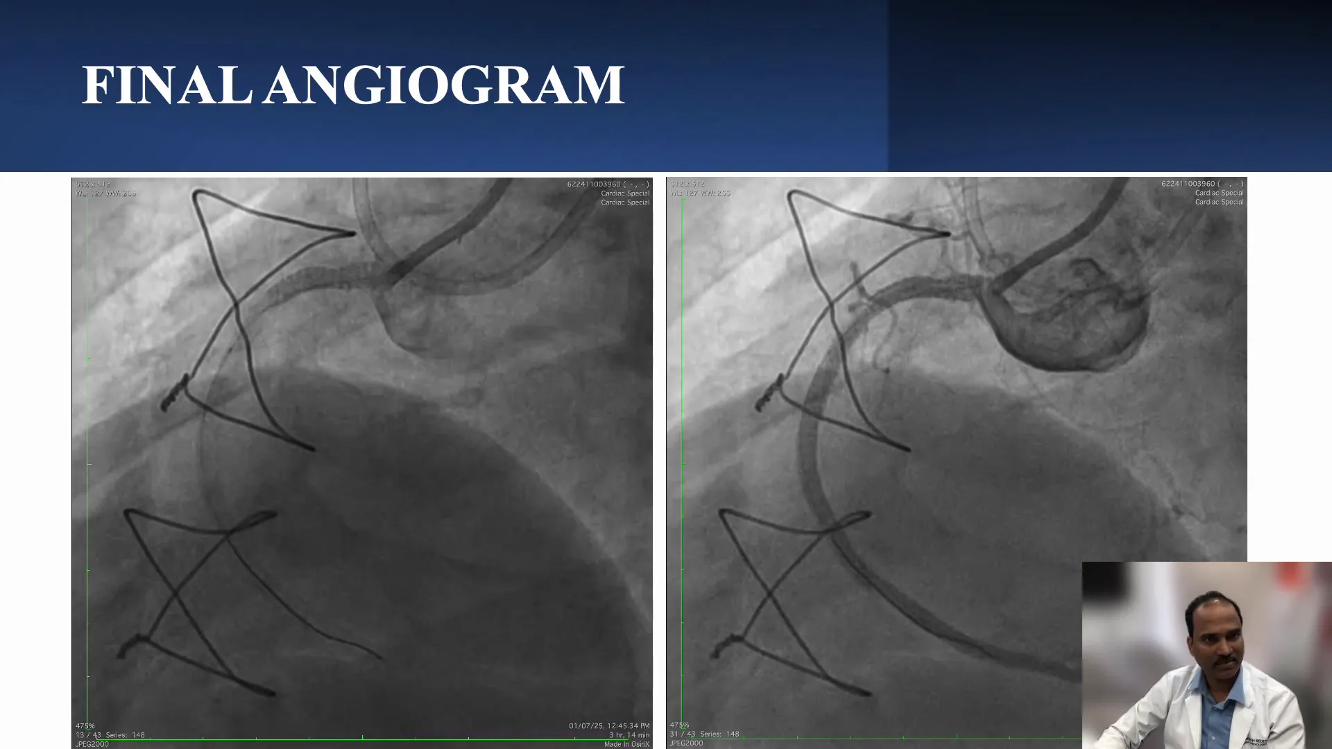 Final angiographic result showing patent RCA after facilitated ADR and stenting