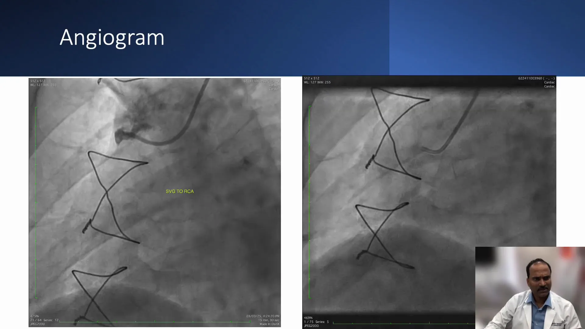 Coronary angiogram showing occluded SVG to RCA and native RCA with total occlusion
