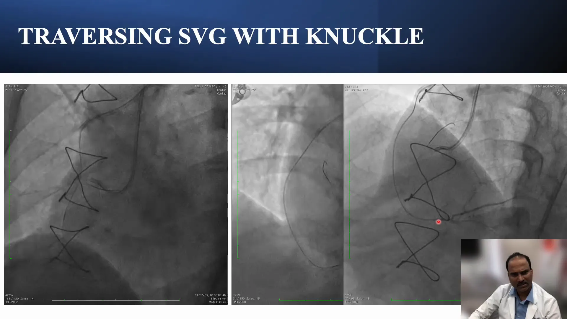 Knuckling technique to cross occluded SVG to RCA