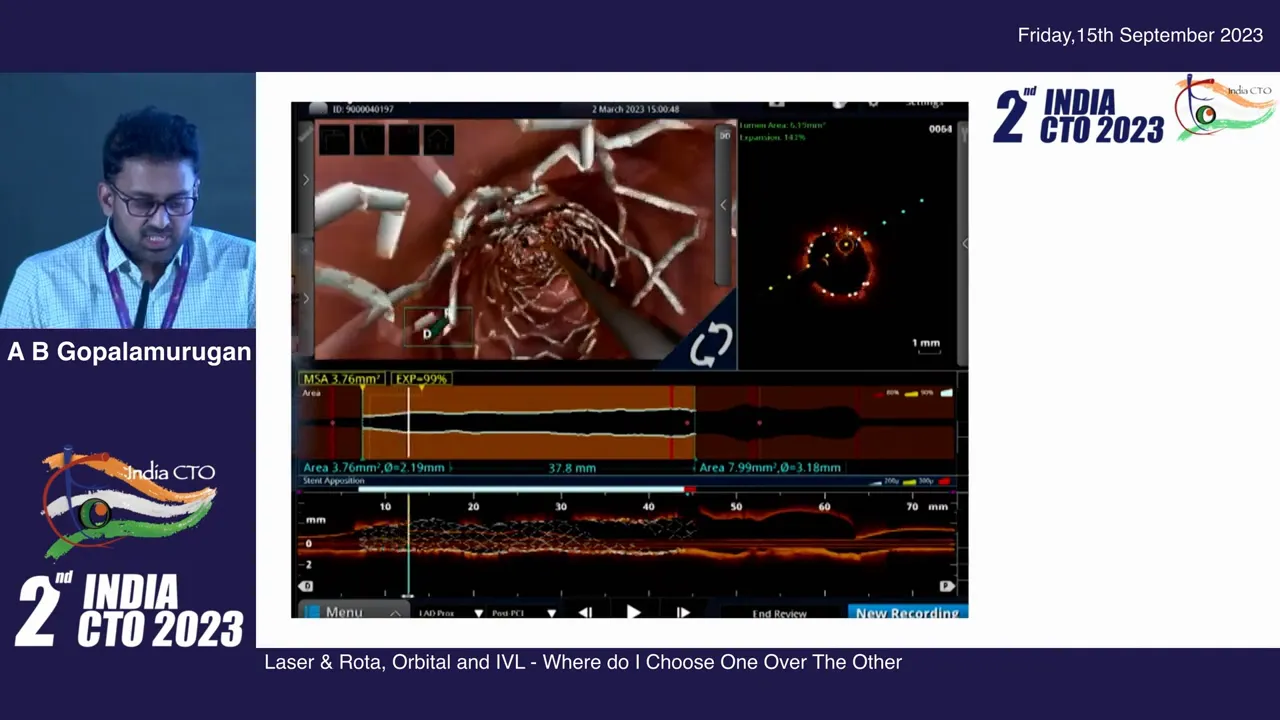 Final cross-sectional 3D rendering showing good minimum stent area after combined therapy