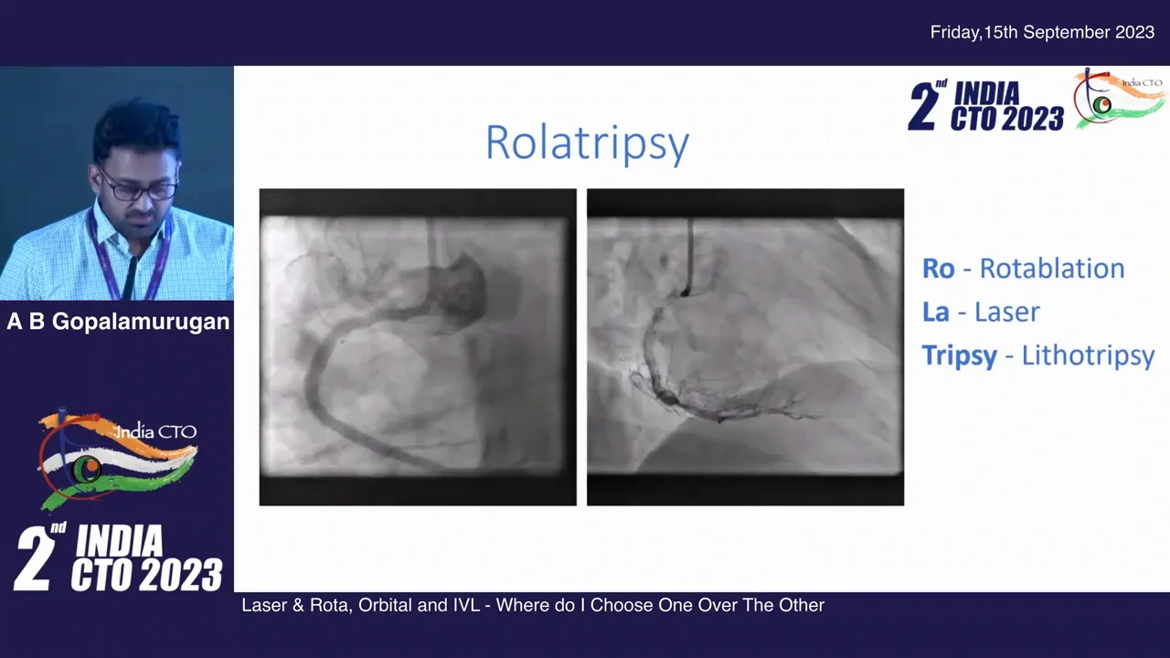 Post-lithotripsy balloon dilatation showing improved expansion