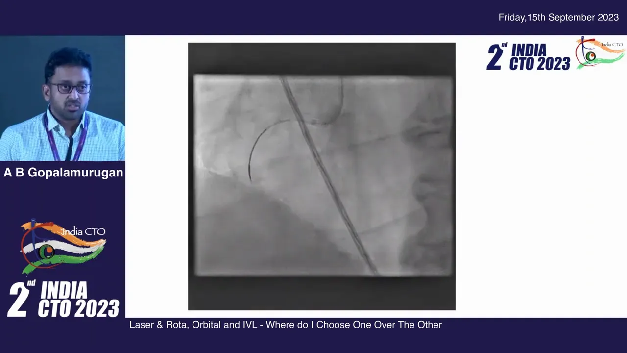 Microcatheter slightly wedged but unable to cross calcific lesion