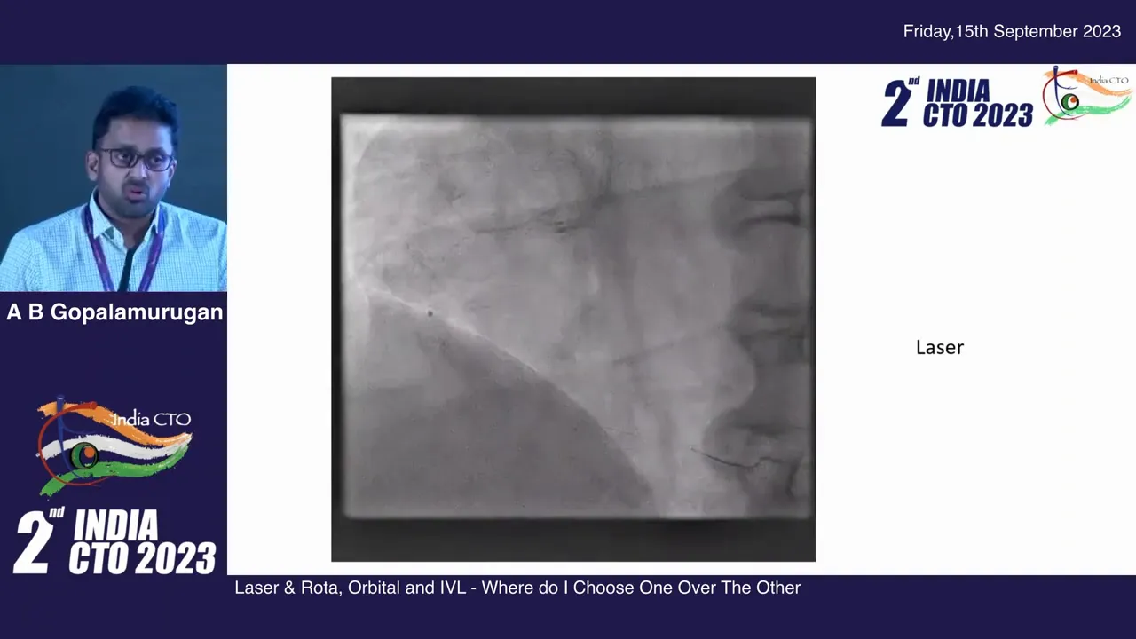 ELCA (excimer laser) catheter being used to create a channel