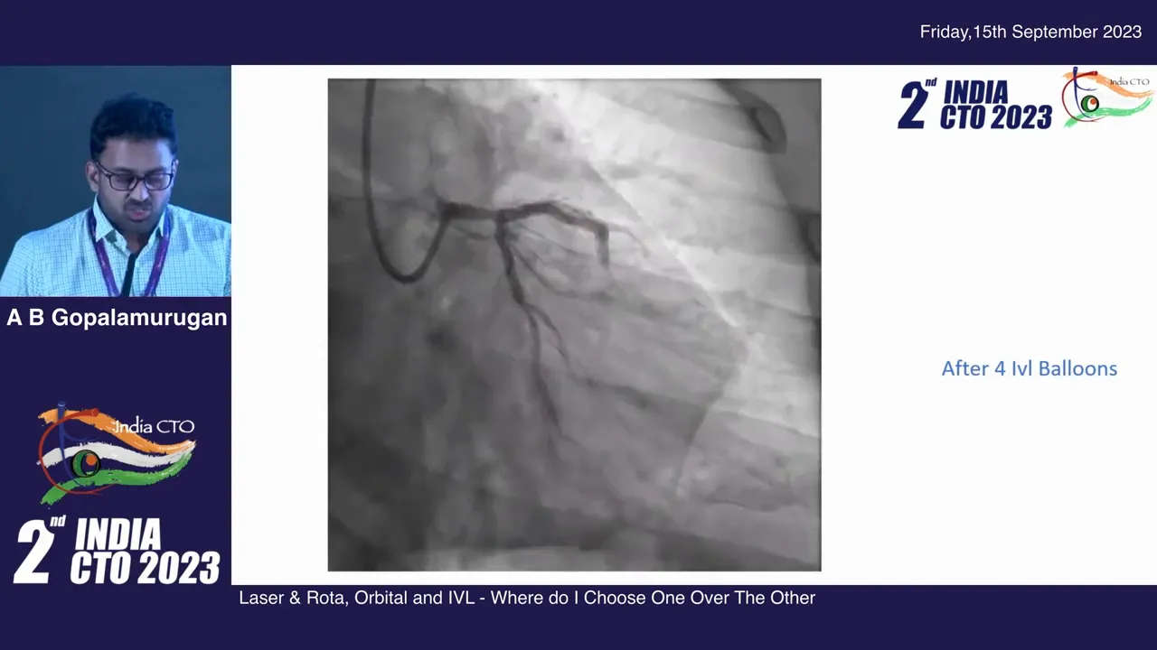 Lithotripsy balloon in proximal lesion during IVL therapy