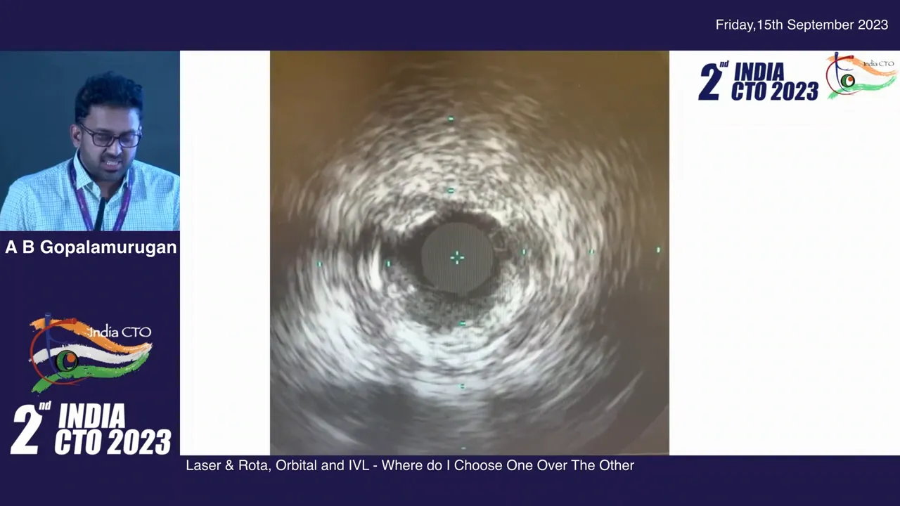 IVUS image showing calcific instant restenosis inside an old stent
