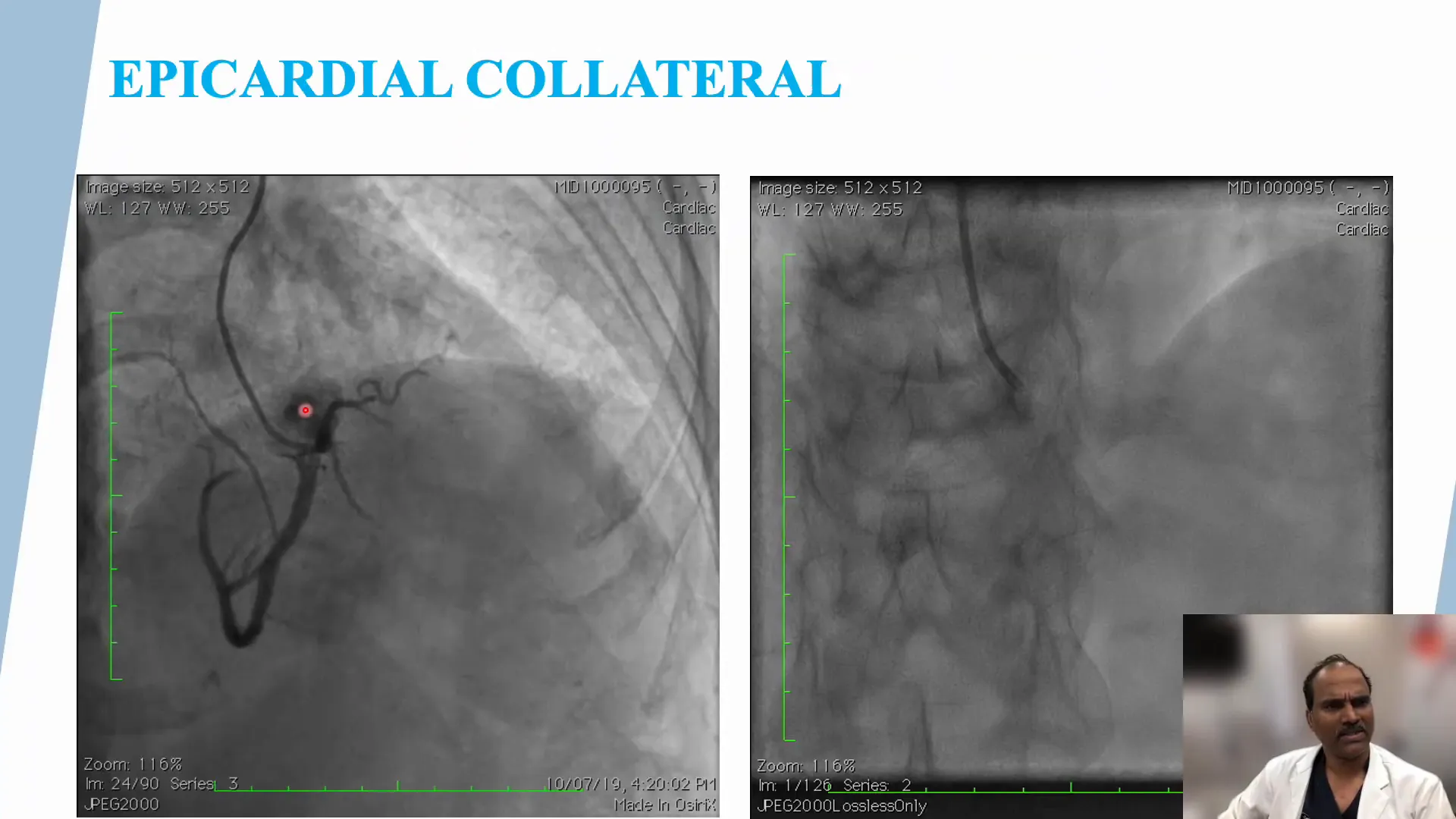 Venous graft example