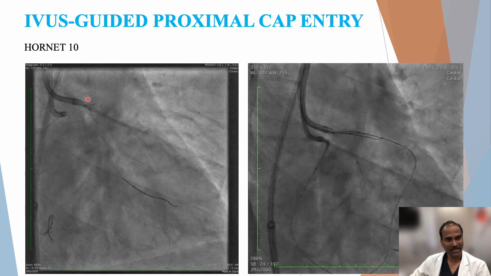 IVUS-guided cap puncture example