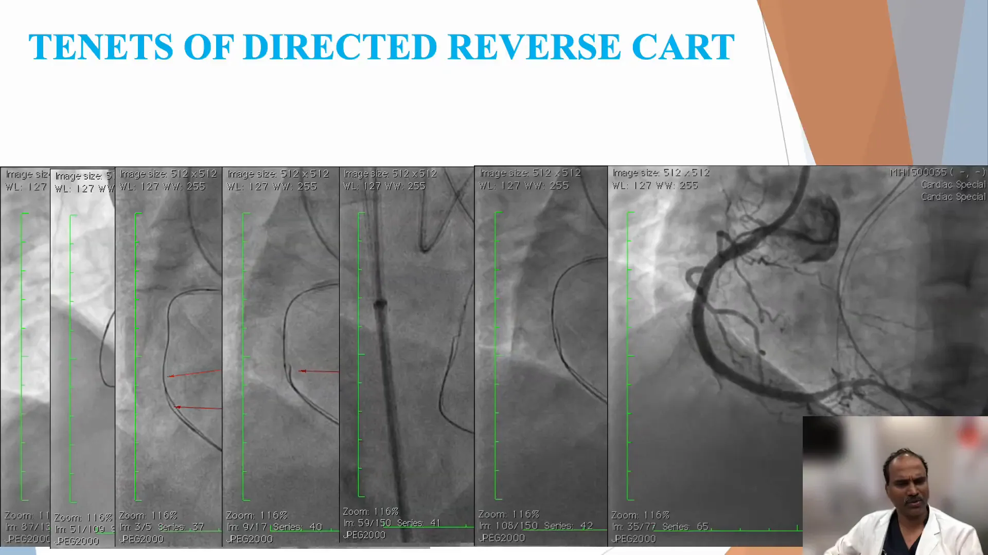 Reverse CART technique