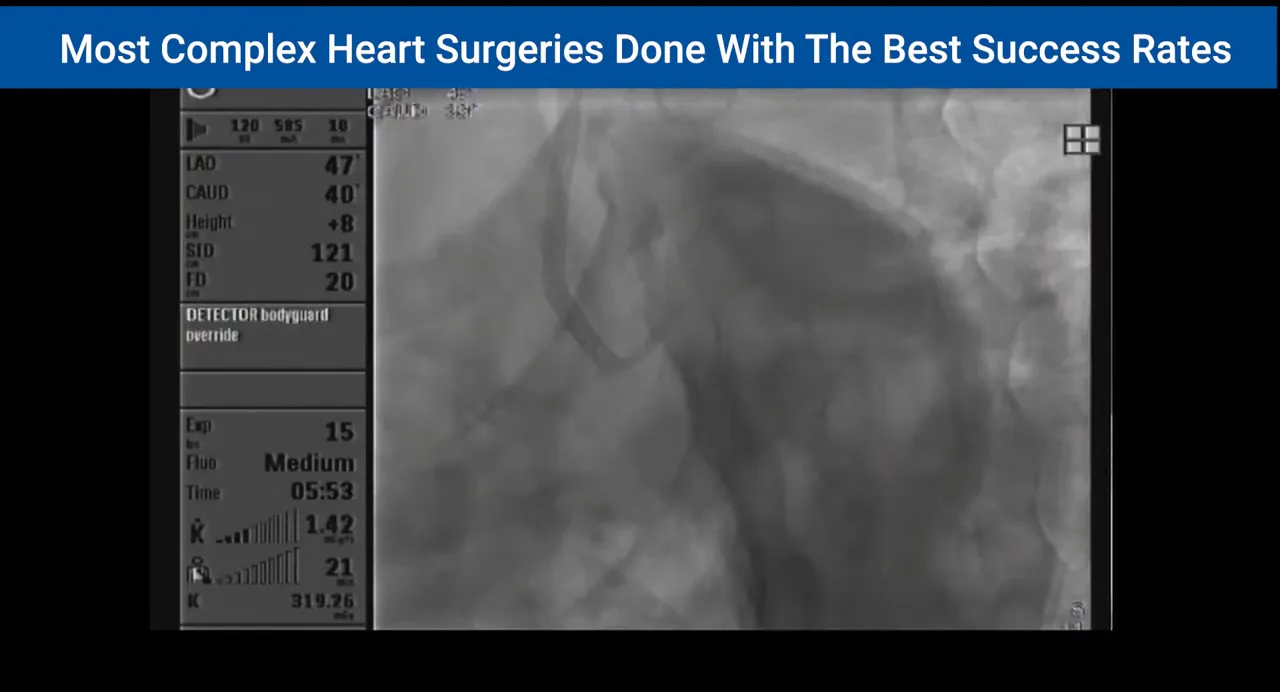 LAO angiogram with catheter tip tracking into left circumflex (LCX)
