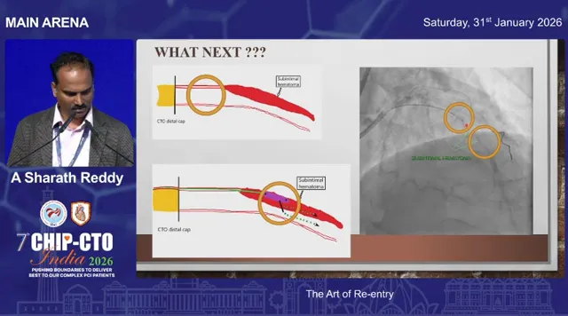 Slide showing CTO diagrams and angiogram with circled re-entry zones and labeled subintimal hematoma