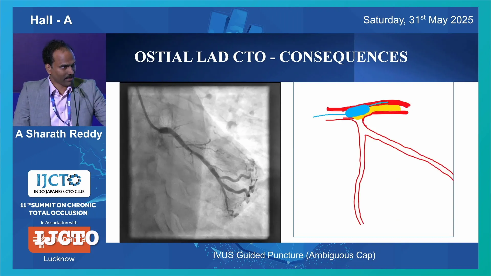 Ambiguous proximal cap in CTO intervention