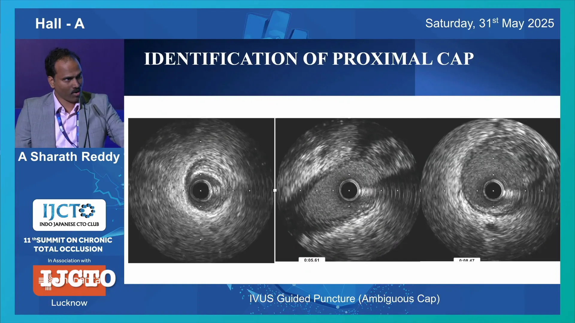 IVUS image showing disappearance of media and vessel size jump